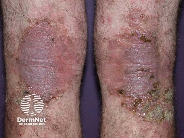 Severe atopic dermatitis unresponsive to topical therapies, phototherapy, and methotrexate - candidate for a JAK inhibitor