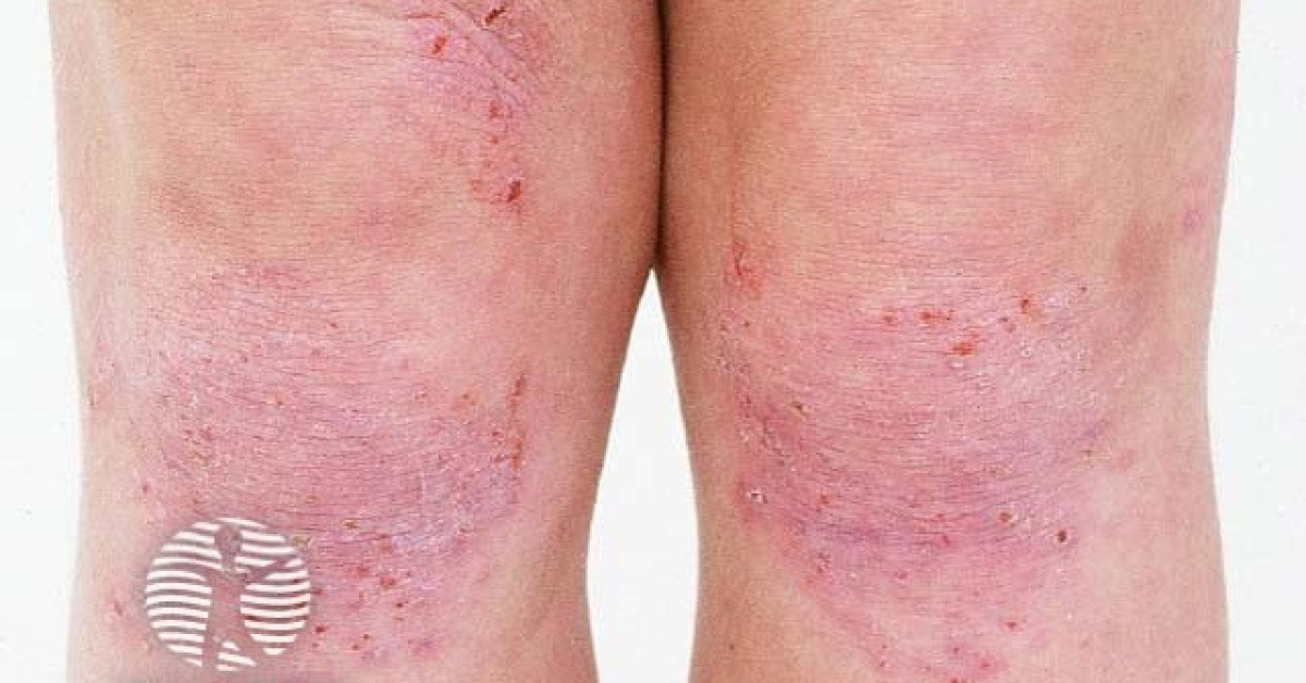 Atopic dermatitis image