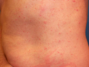 Autosensitisation dermatitis