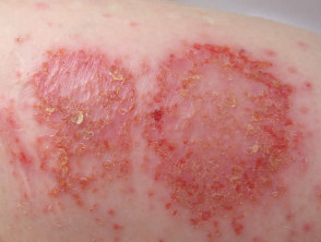 Exudative nummular dermatitis