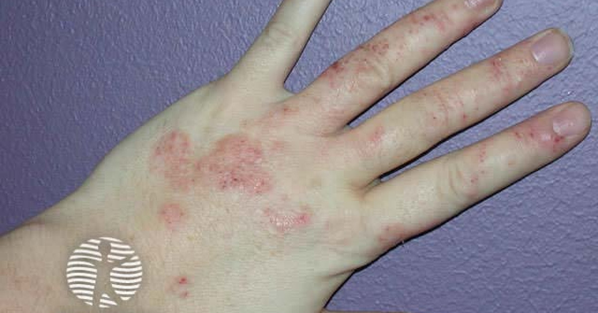 Dry discoid eczema image