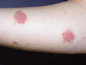 Exudative nummular dermatitis