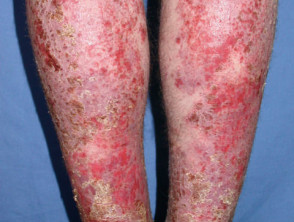 Autosensitisation dermatitis