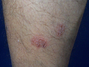 Dry discoid eczema