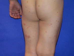 Dry discoid eczema