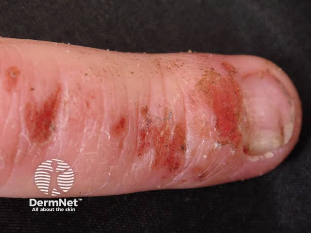 Atopic dermatitis on the finger with nail changes