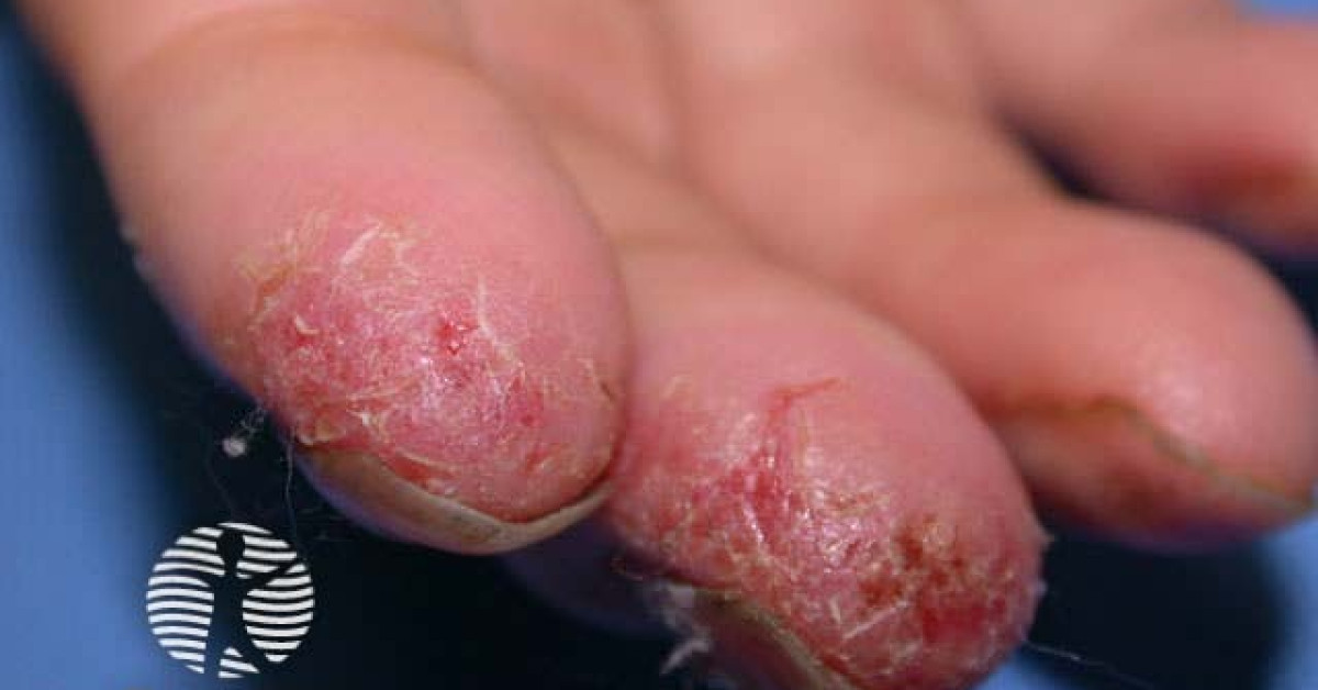 Hand dermatitis image