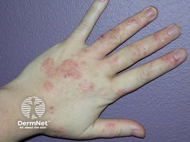 Hand dermatitis