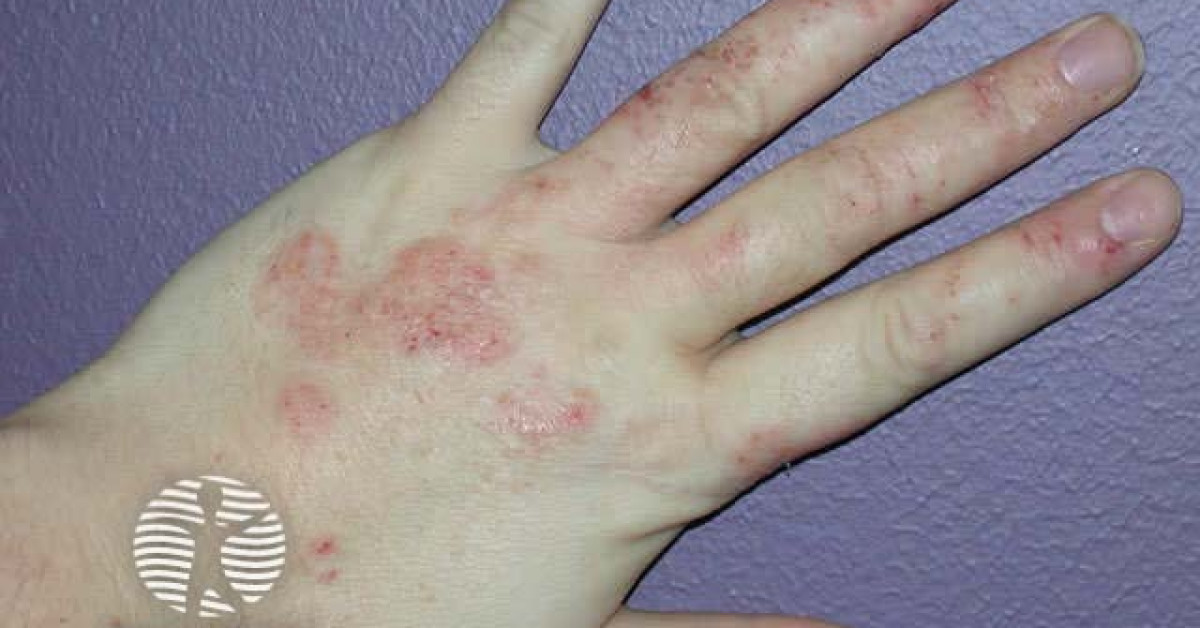 DermNet® - Hand dermatitis image