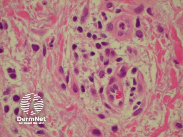 Dermal inflammatory infiltrate