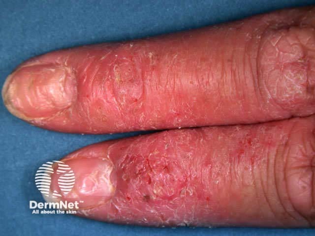 Chronic irritant hand dermatitis