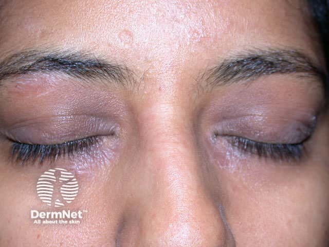 Eyelid dermatitis of unknown cause