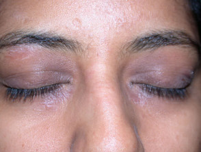 Eyelid dermatitis