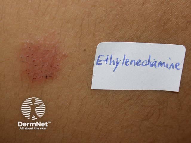 Positive patch test to ethylenediamine, present in a cream the patient was applying to itchy patches