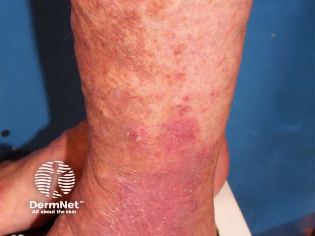 Venous eczema