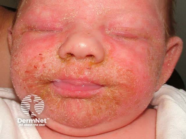 Infantile seborrhoeic dermatitis