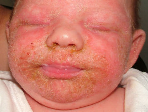 Infantile seborrhoeic dermatitis	