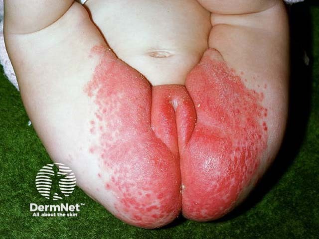 Infantile seborrhoeic dermatitis