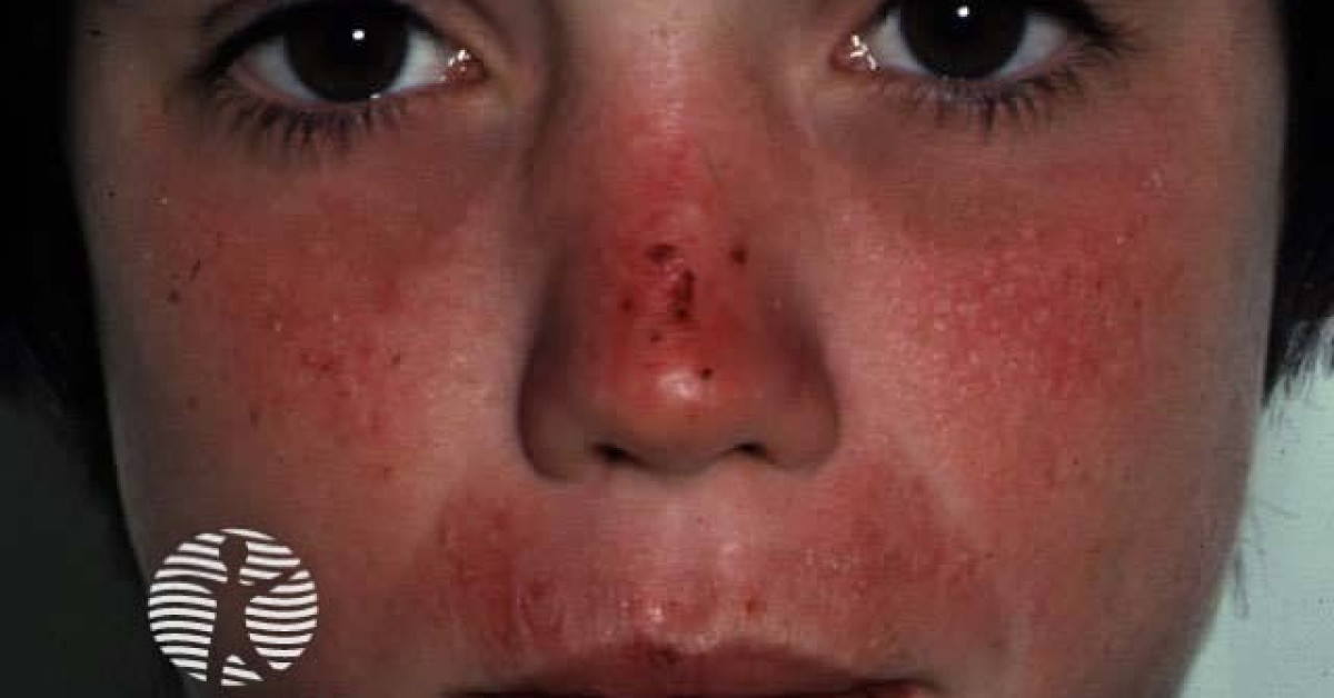 Prugio Rash Actinic prurigo image