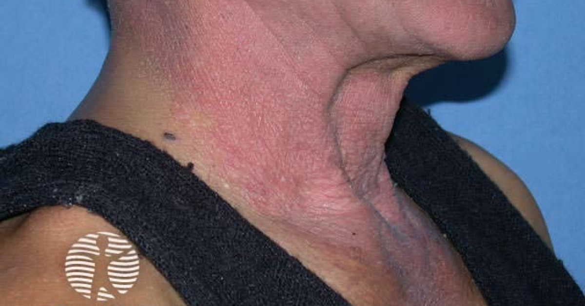 Reaction to chlorpromazine image