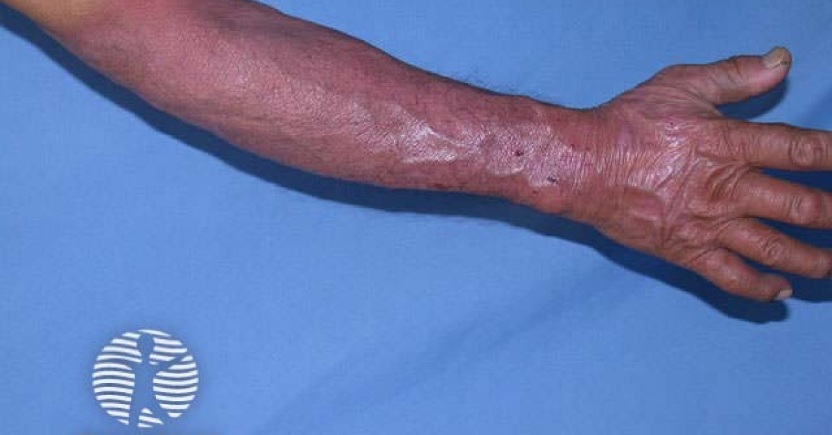 Reaction to chlorpromazine image