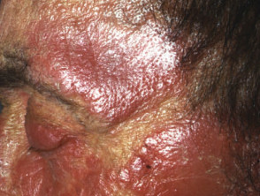 Chronic photosensitivity dermatitis