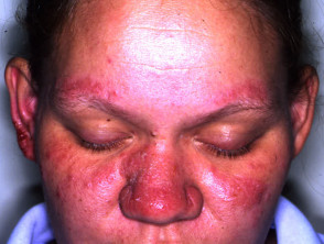 Photoaggravated atopic dermatitis