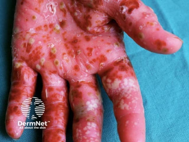 Palmar pustulosis