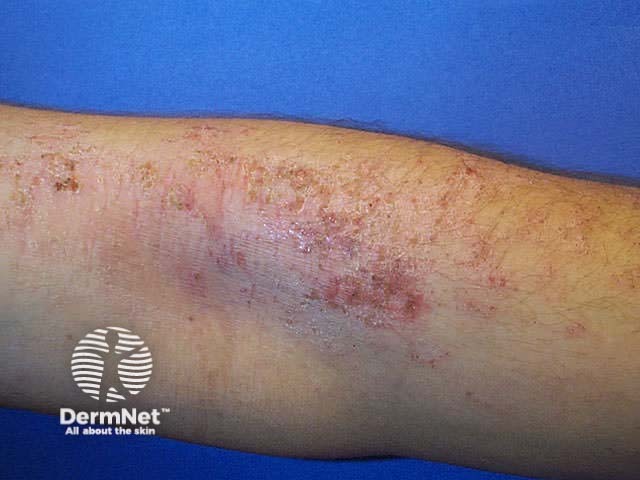 Subacute dermatitis