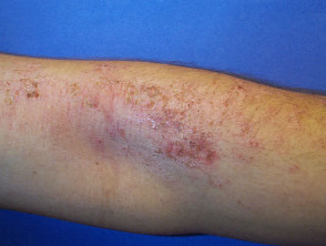 Subacute dermatitis