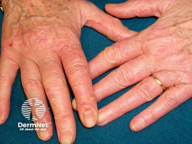 Subacute dermatitis