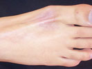 Atrophy and hypopigmentation due to intralesional steroids