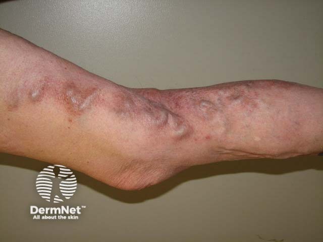 Varicose eczema