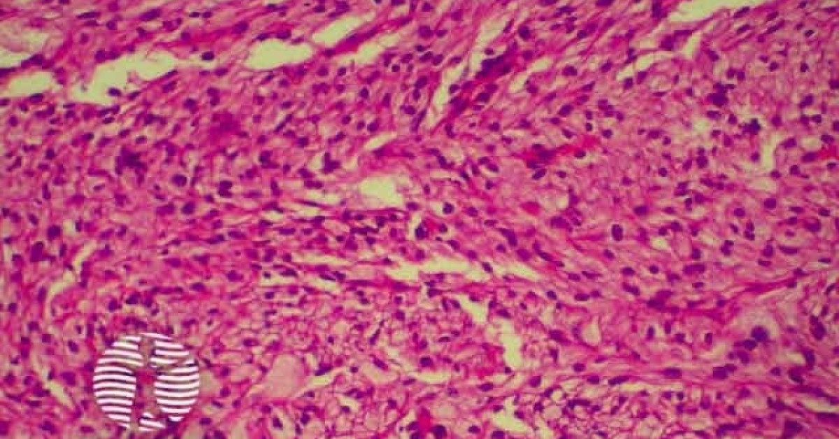 pathology of atypical fibroxanthoma image