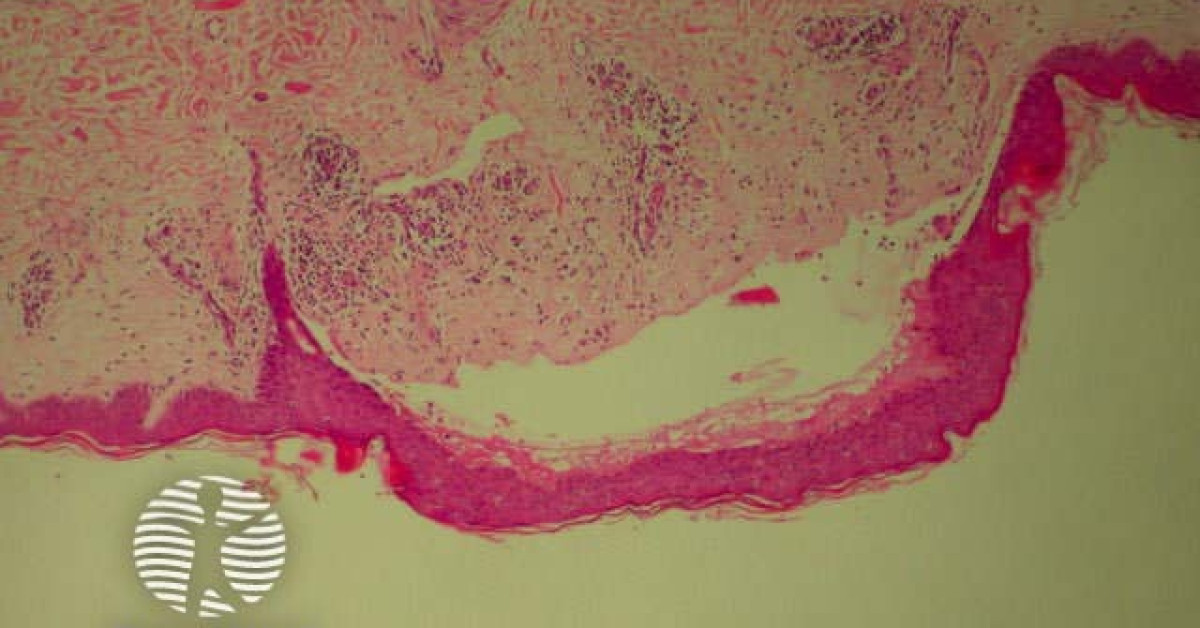 Bullous Rash Pathology Bullous pemphigoid image