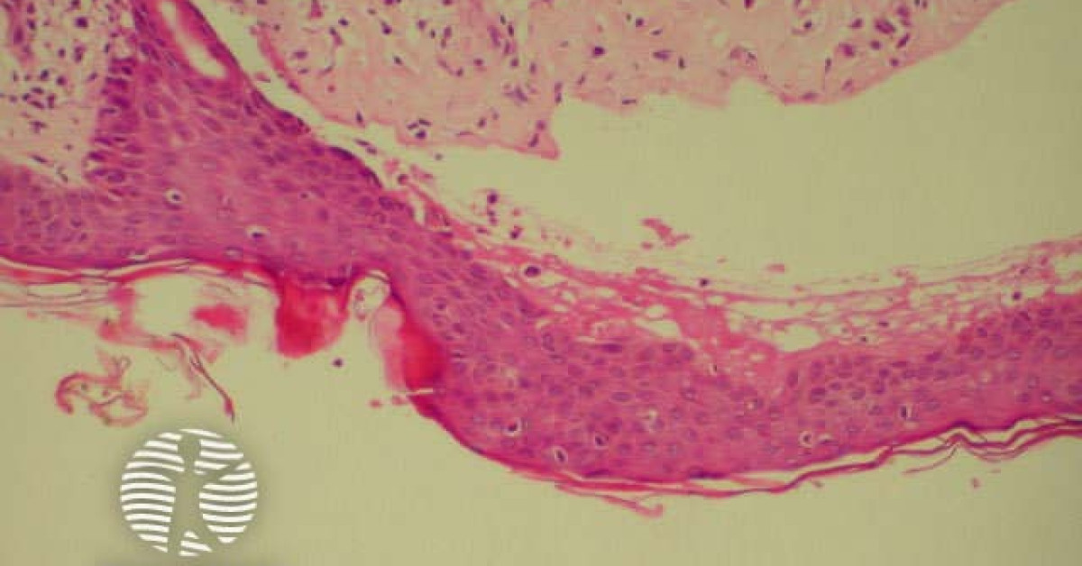 Bullous Rash Pathology Bullous pemphigoid image