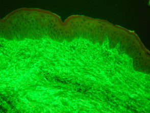 Pathology of immunofluorescence