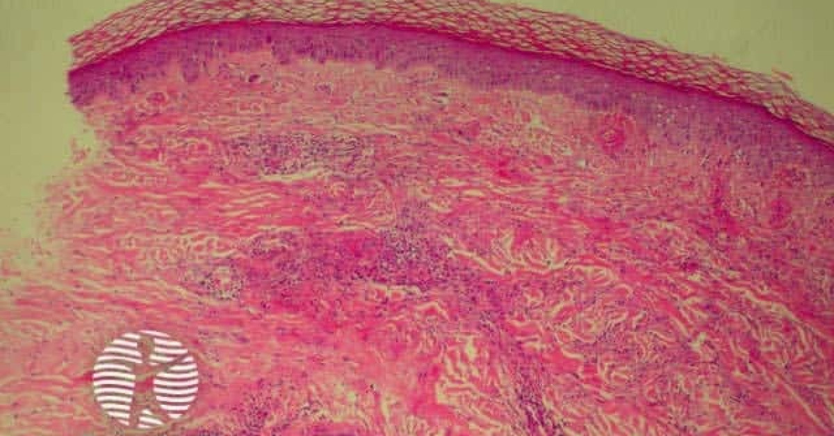 Leucocytoclastic vasculitis image