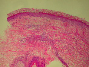 Leucocytoclastic vasculitis