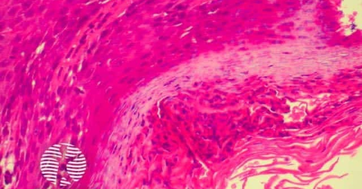 Parakeratosis image