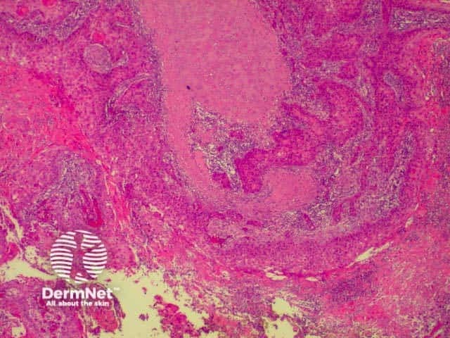 Pathology of SCC