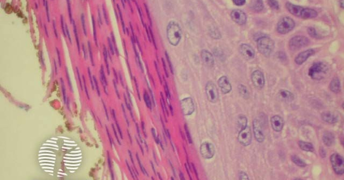 Pathology Of Actinic Keratosis Image