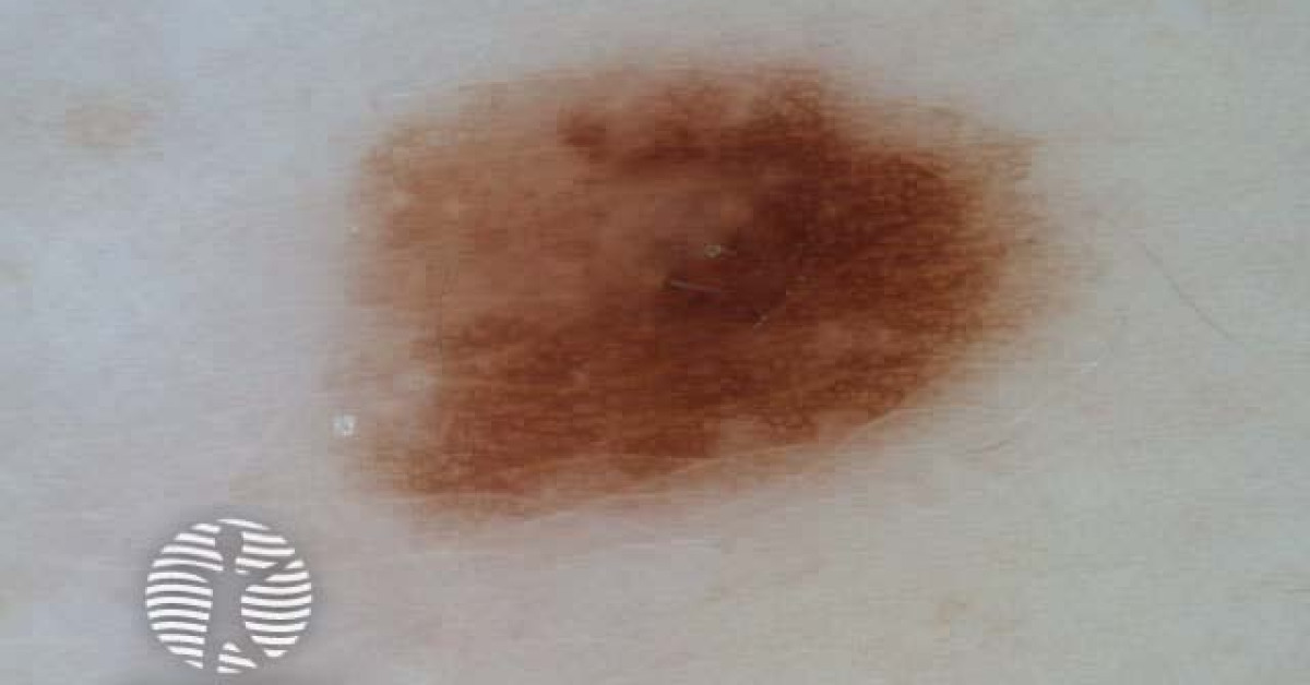 Dermoscopy image