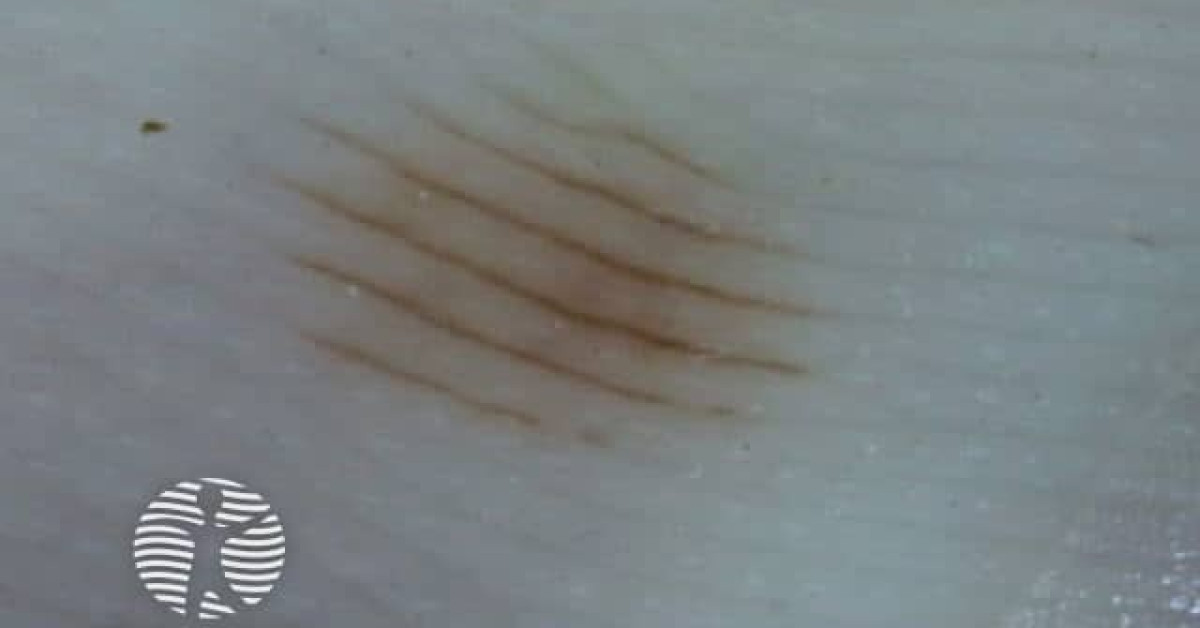 Parallel furrow pattern image