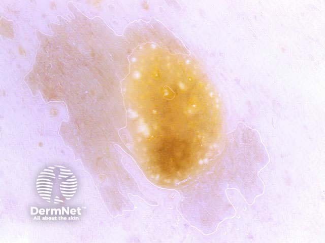 Seborrhoeic keratosis