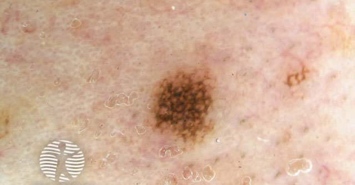 Dermoscopy. Regular pseudonetwork. Naevus image