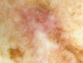 Dermoscopy. Scar-like depigmentation. Melanoma