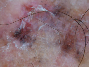 Pigmented basal cell carcinoma dermoscopy
