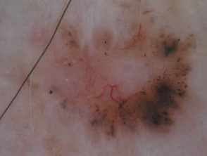 Branching serpentine vessels, leaf-like structures, blue-grey and brown dots in pigmented basal cell carcinoma dermoscopy