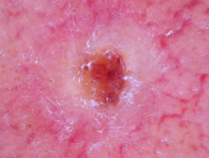 Nonpigmented basal cell carcinoma dermoscopy
